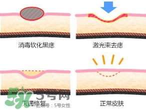 藥水點(diǎn)痣和激光點(diǎn)痣哪個(gè)好？各有什么優(yōu)缺點(diǎn)