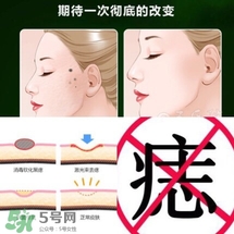 藥水點(diǎn)痣和激光點(diǎn)痣哪個(gè)好？各有什么優(yōu)缺點(diǎn)