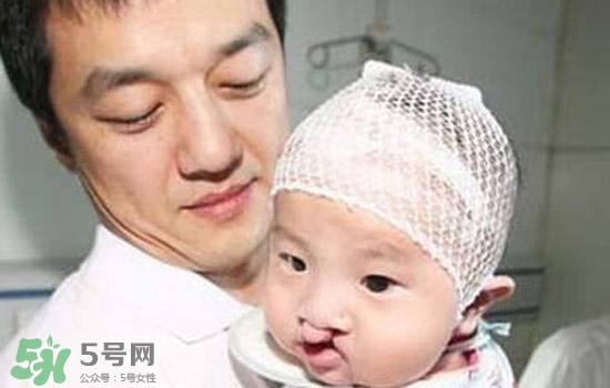 兔唇是什么？兔唇是什么原因造成的？