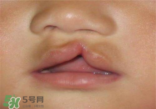 兔唇能檢查出來嗎？兔唇能完全修復(fù)嗎？