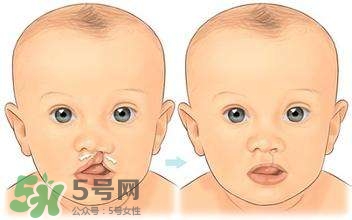 兔唇能檢查出來嗎？兔唇能完全修復(fù)嗎？
