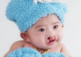 兔唇可以治嗎？兔唇修補術(shù)