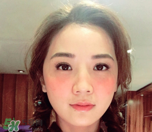 夏天可以點(diǎn)痣嗎？夏天點(diǎn)痣后要注意什么？