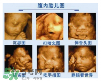 四維彩超有必要做嗎？四維彩超檢查不出什么？