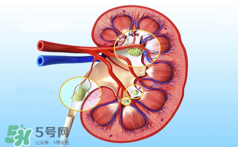 腎結(jié)石有什么癥狀？腎結(jié)石原因