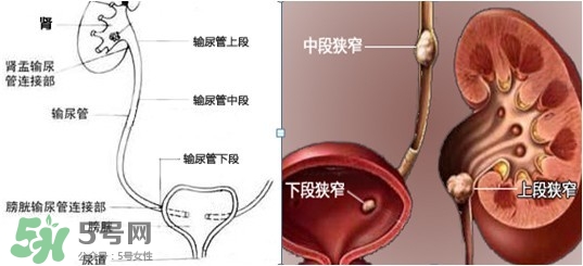 腎結石怎么治最好？腎結石的醫(yī)治方法