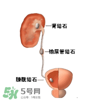 腎結(jié)石有什么癥狀？腎結(jié)石原因