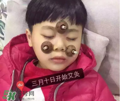 艾灸貼可以治咳嗽嗎？艾灸貼可以治退燒嗎？
