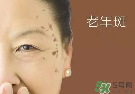 老年斑多大年齡開(kāi)始有？為什么牙膏能去老年斑？
