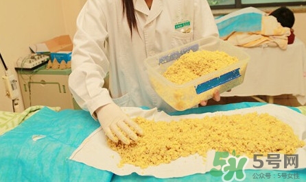 隔姜灸效果怎么樣？隔姜灸好還是直接灸好