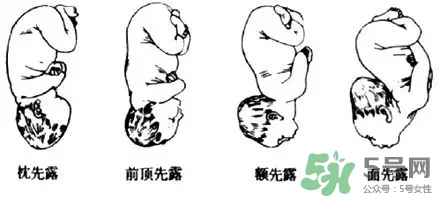 胎位不正能順產(chǎn)嗎？胎位不正怎么辦？