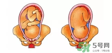 胎位不正能順產(chǎn)嗎？胎位不正怎么辦？