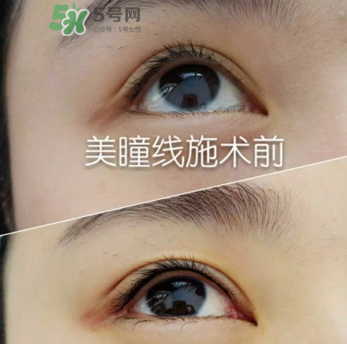 做美瞳線可以吃雞蛋嗎？做美瞳線能吃雞蛋嗎？