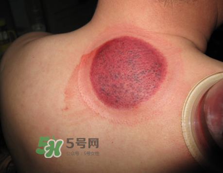 三伏天拔罐后多久可以洗澡？三伏天拔罐后注意事項(xiàng)
