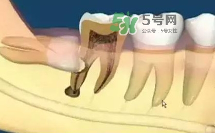 智齒是每個人都會長嗎？拔智齒能瘦臉嗎？