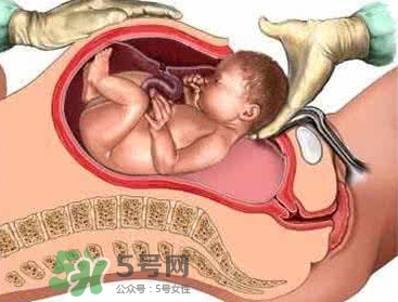 剖腹產(chǎn)比順產(chǎn)安全嗎？剖腹產(chǎn)產(chǎn)后注意事項？
