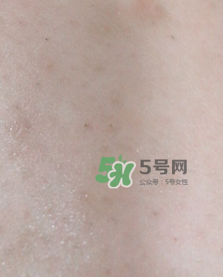 Dermatix舒痕疤痕膏有效嗎？Dermatix舒痕疤痕膏怎么用？