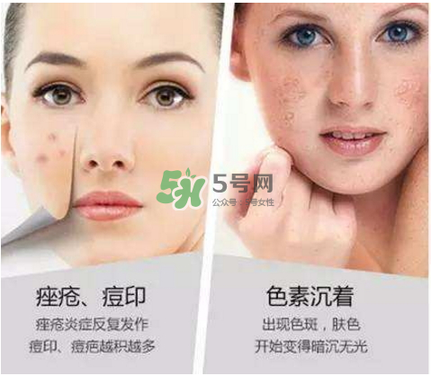 果酸換膚自己可以做嗎？果酸換膚后注意事項