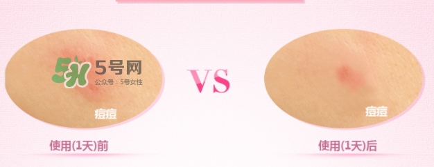 3m痘痘貼怎么用？3m痘痘貼貼多久？