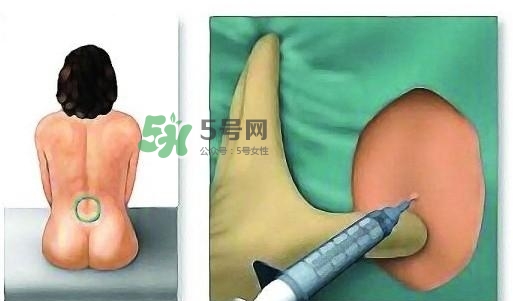 無(wú)痛分娩為什么不提倡？無(wú)痛分娩有后遺癥嗎？