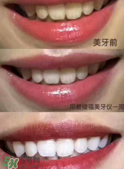 美牙儀能用水洗嗎？美牙儀能用多久？