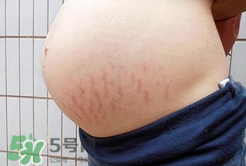妊娠紋什么時候開始預(yù)防？妊娠紋什么時候消除？