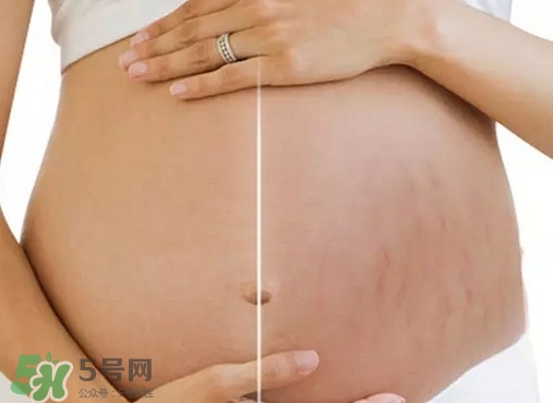 脖子上會長妊娠紋嗎？妊娠紋長在哪些地方？