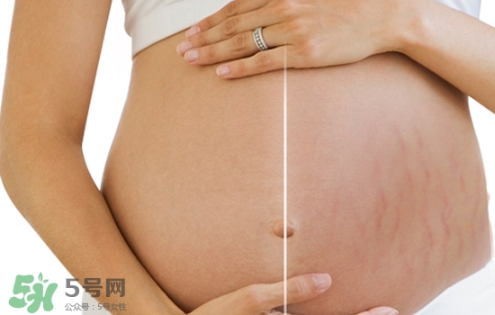 妊娠紋在左邊生男或女？怎么從妊娠紋看男女？
