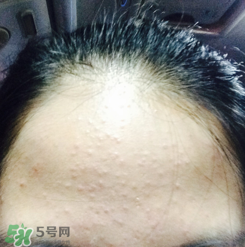 長(zhǎng)痘長(zhǎng)閉口怎么辦？長(zhǎng)痘長(zhǎng)閉口是什么原因？