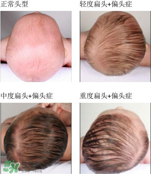 寶寶頭型是睡出來的嗎？寶寶頭型矯正最佳時間