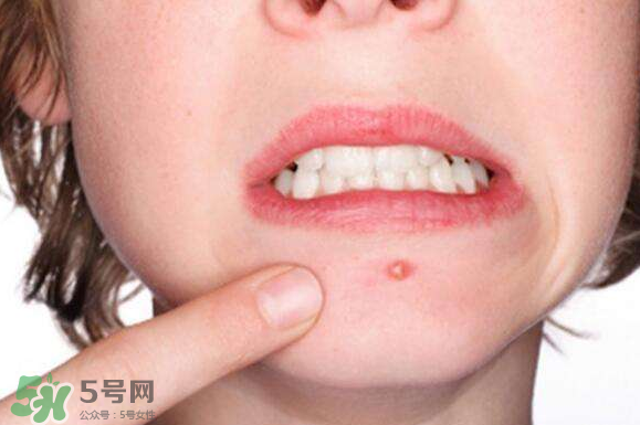 暗瘡可以擠壓?jiǎn)?？油性和骯臟肌膚會(huì)容易有暗瘡嗎？