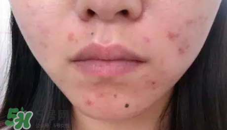 痤瘡和毛囊炎一樣嗎？痤瘡與毛囊炎區(qū)別