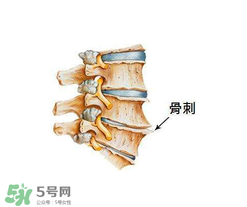 骨刺是怎么形成的？骨刺怎么治療？