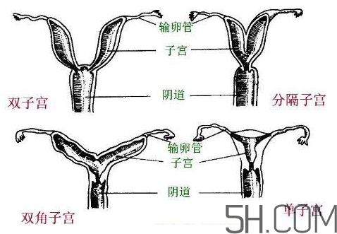 子宮畸形有哪些？子宮畸形有什么影響？