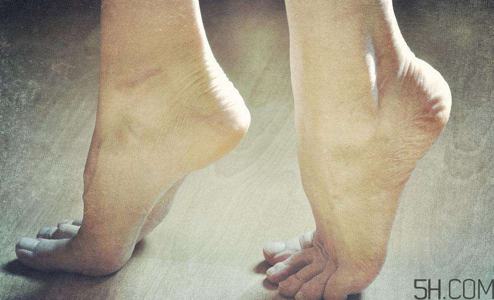 腳氣是什么原因引起的？腳氣是濕氣重引起的嗎?