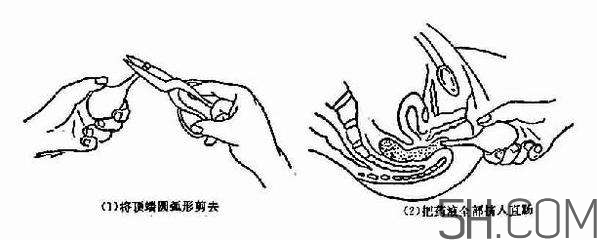 開塞露怎么用？開塞露用后多久會排便？