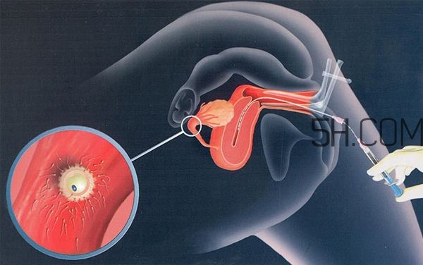 人工授精取卵子怎么?。咳斯な诰腥嗽鯓尤【?？