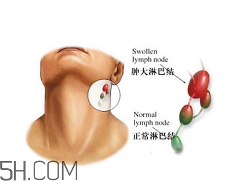 淋巴癌能活多久？淋巴癌癥狀有哪些