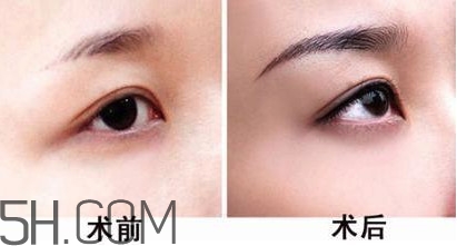 切眉手術(shù)后老得快嗎？切眉能保持多久？