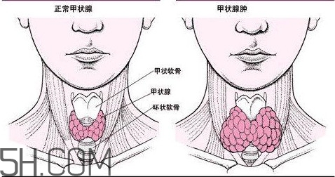 甲狀腺結(jié)節(jié)與甲狀腺腫瘤的區(qū)別有哪些？甲狀腺結(jié)節(jié)可以艾灸嗎