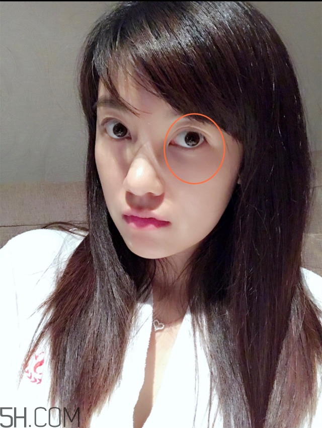 黑眼圈怎么去除既簡(jiǎn)單有容易 看類型與程度