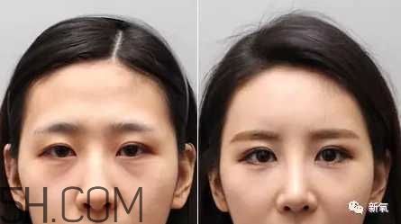 黑眼圈怎么去除既簡(jiǎn)單有容易 看類型與程度