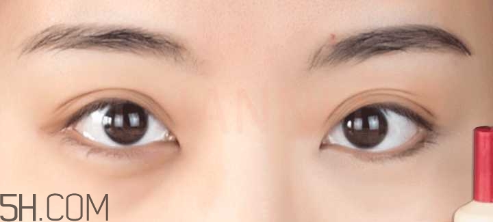 黑眼圈怎么去除既簡(jiǎn)單有容易 看類型與程度