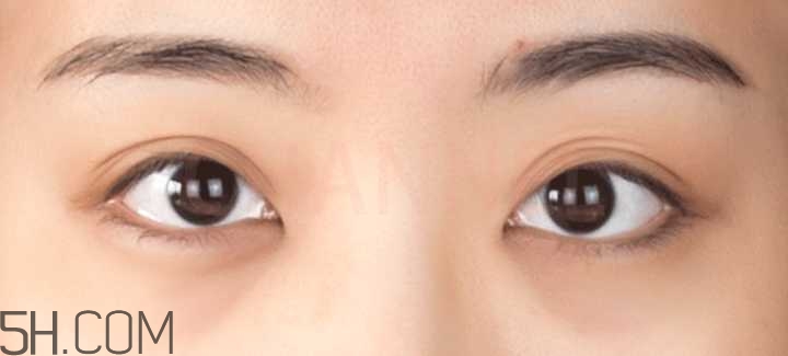 黑眼圈怎么去除既簡(jiǎn)單有容易 看類型與程度