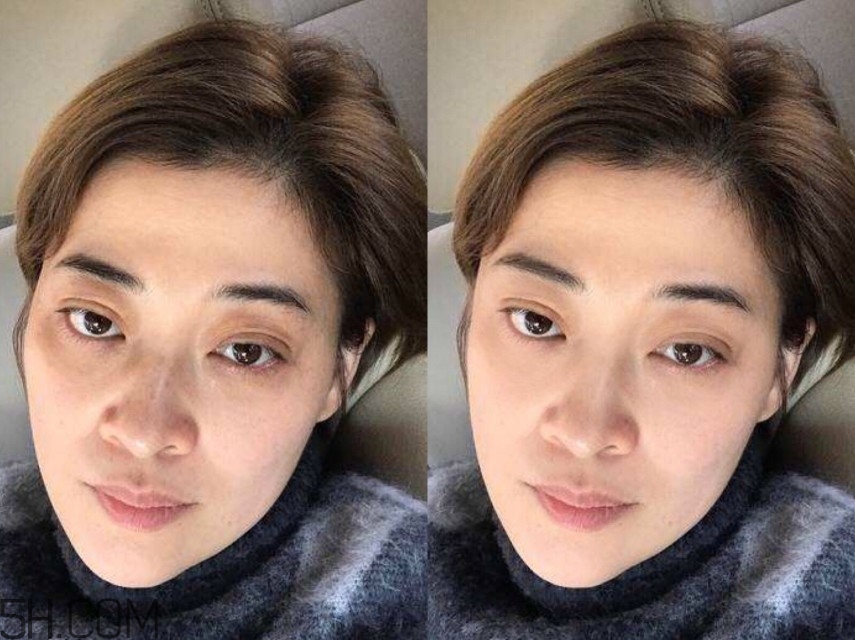 黑眼圈怎么去除既簡(jiǎn)單有容易 看類型與程度