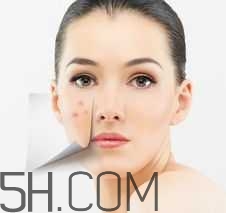 濕熱型痤瘡是什么？怎么調(diào)理濕熱型痤瘡？