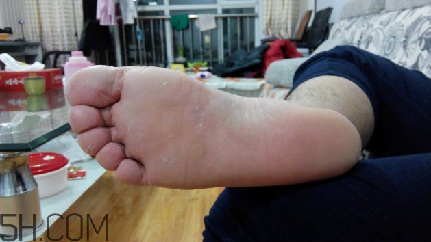腳氣可以用酒精消毒嗎？腳氣可以用碘伏消毒嗎？