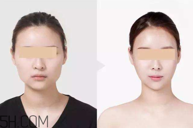 打瘦臉針可以抽煙嗎？打瘦臉針會反彈嗎？