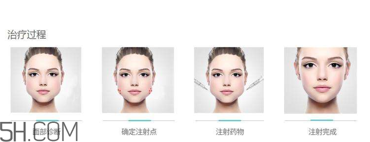 打瘦臉針可以抽煙嗎？打瘦臉針會反彈嗎？