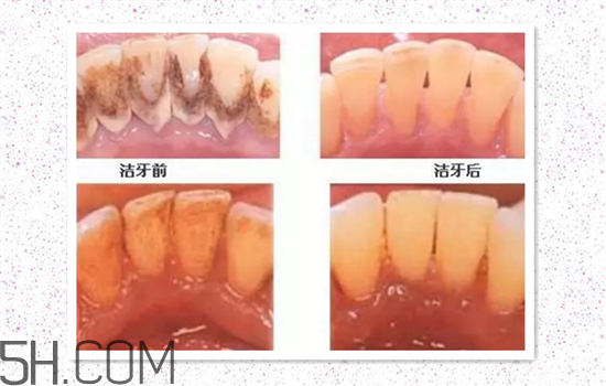 超聲波洗牙可以美白牙齒嗎？超聲波洗牙多少錢一次？